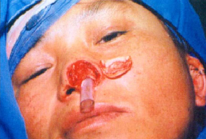 二、耳廓復(fù)合組織瓣游離移植法修復(fù)鼻翼與鼻小柱缺損